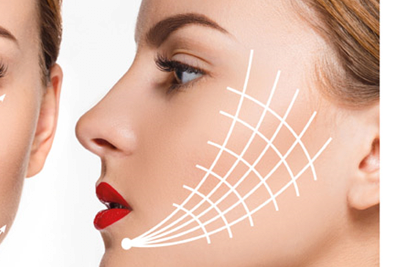 Fadenlifting Fadenlifting ist die moderne Alternative zum klassischen Facelifting