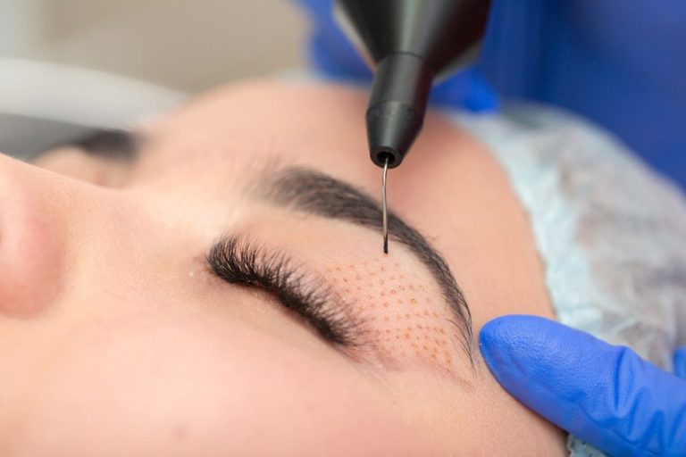 Plasma Pen Behandlung Plasma Pen Behandlung in Bonn – Sichtbare Lidstraffung ohne Operation
